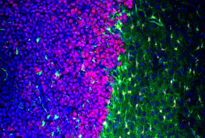 Scar-forming astrocytes shape and function altered in response to glioma